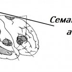Схема мозга при семантической афазии
